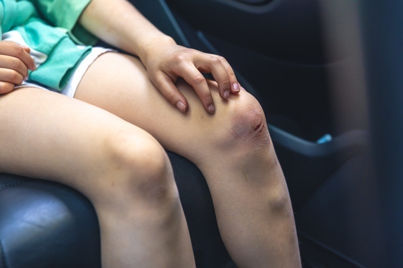 Close-up of little girl holding her bruised injured damaged knee with her hands.
